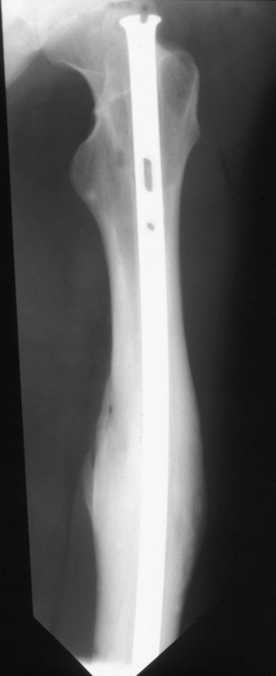 AO Femoral Rod (Implant 271)